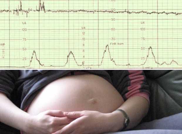 Ошибки и заблуждения о проведении КТГ