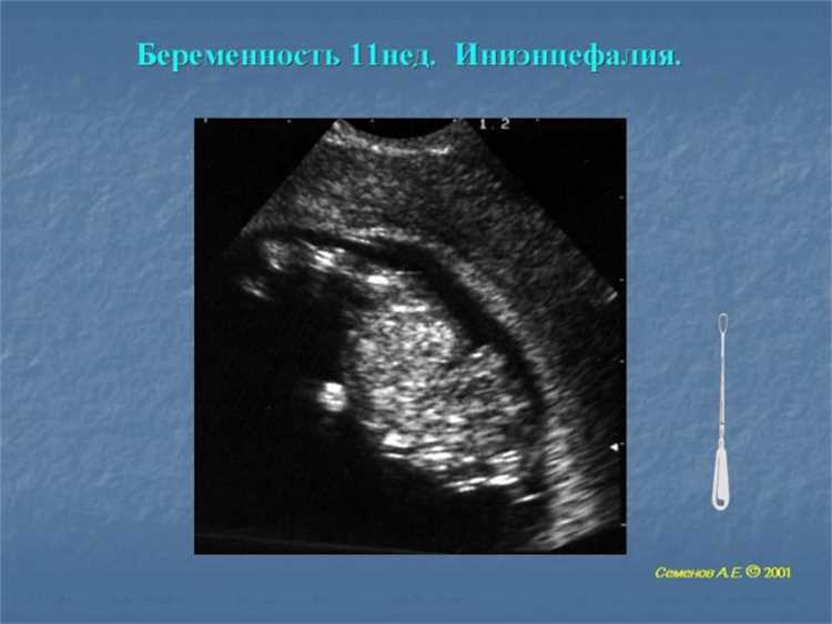 Как ВПР влияет на иммунитет беременной